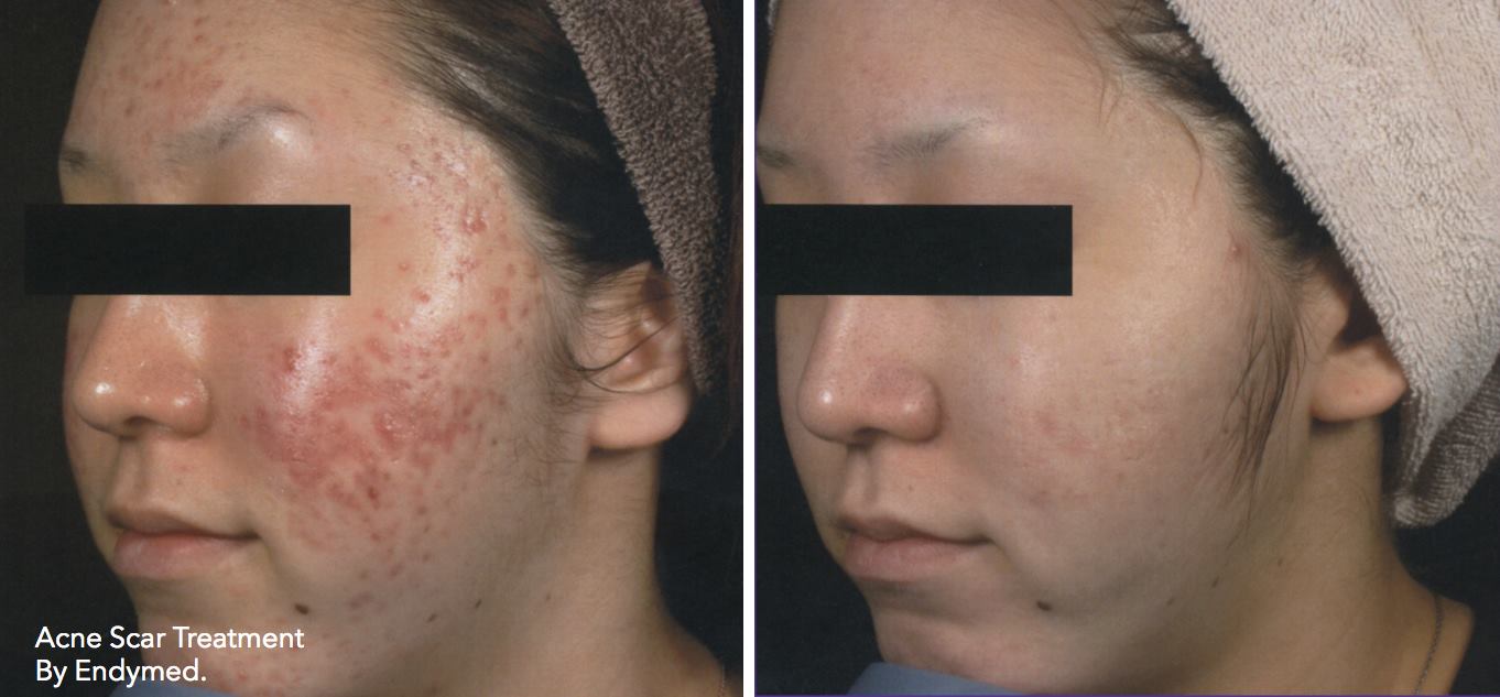 acne b&a 2