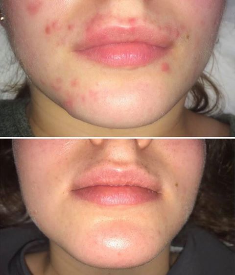 acne b&a