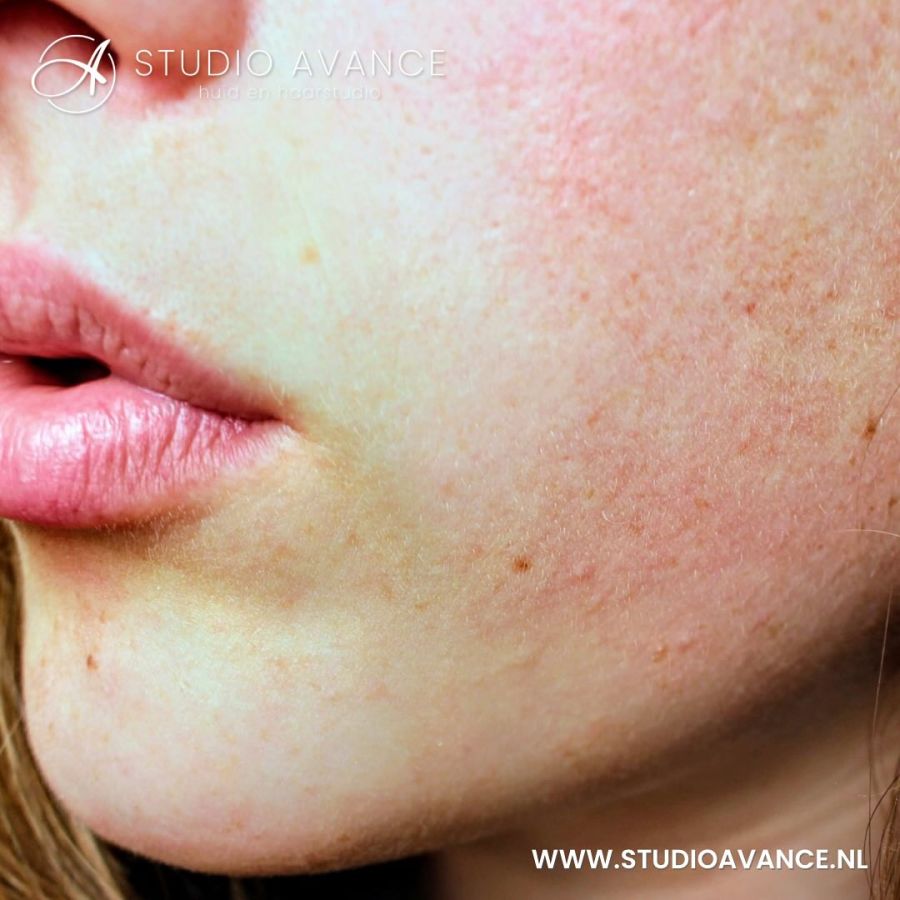 Tips voor een droge huid - Studio Avance